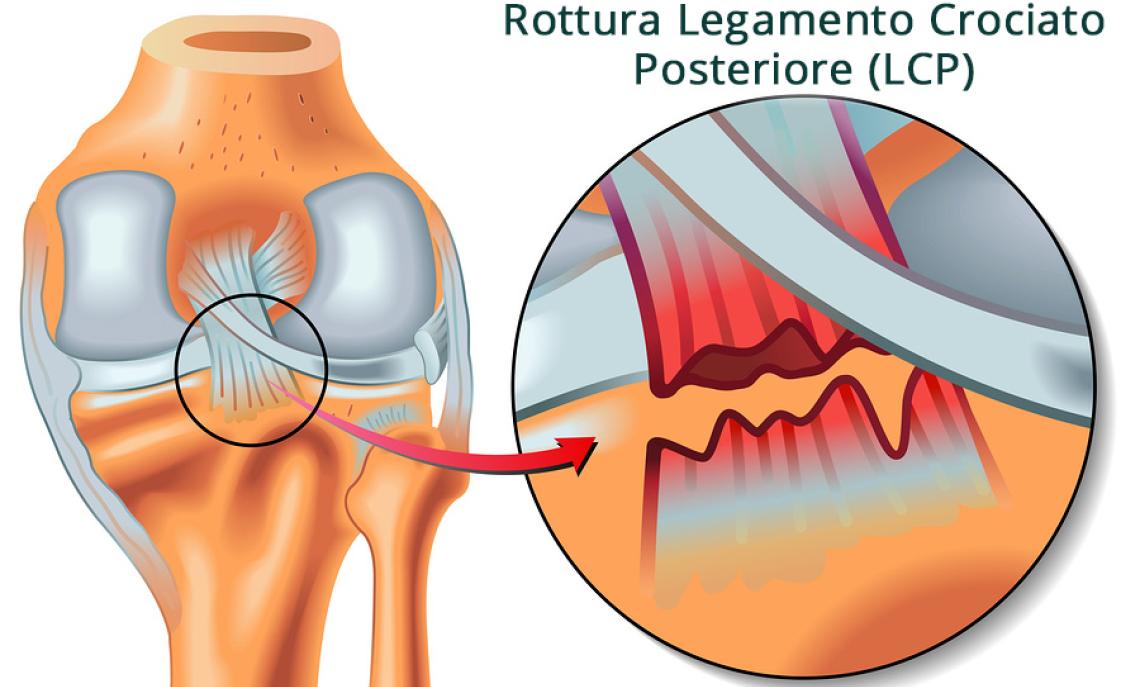 Posterior Cruciate Rupture.eps