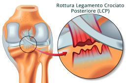 E se si rompe il Legamento Crociato Posteriore?