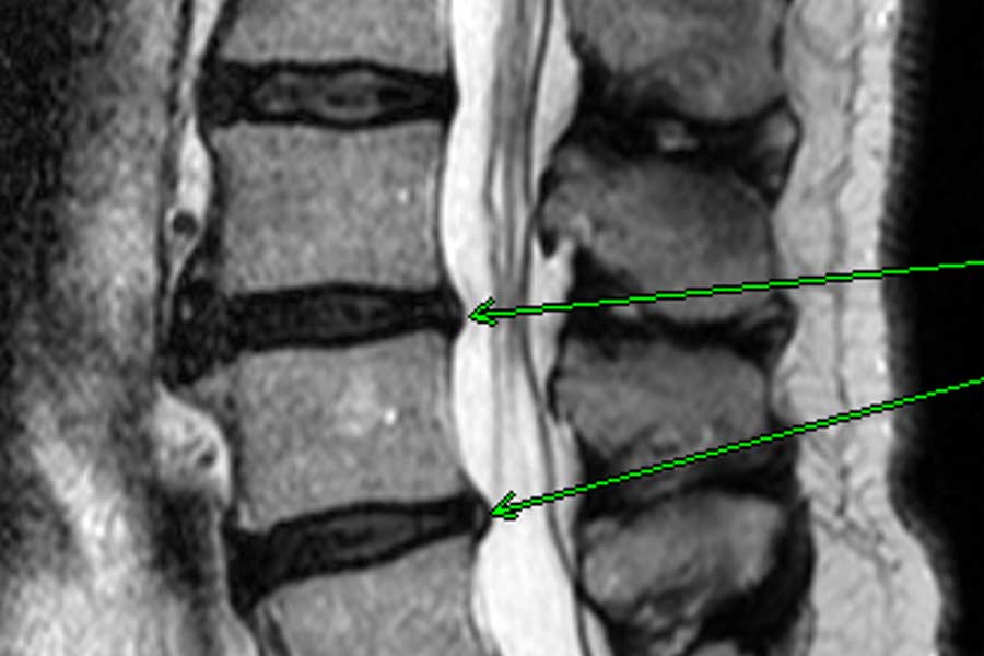 Isokinetic: lombalgia, cosa sapere